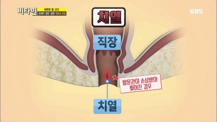 항문이 간지럽다면? | 인스티즈
