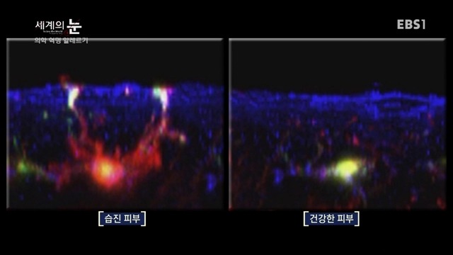 다큐 세계의 눈 - 의학 혁명 알레르기 | 인스티즈