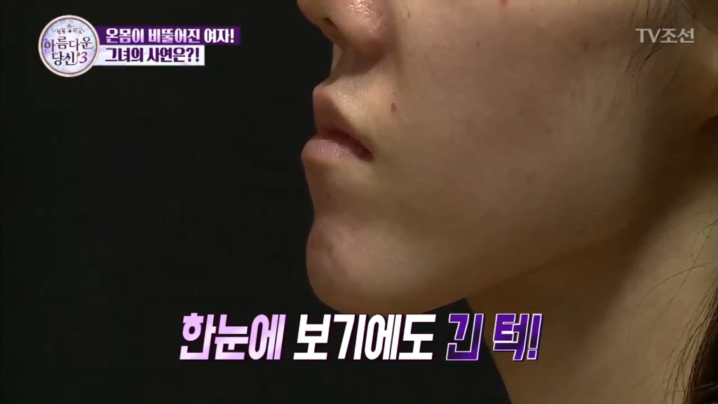 [렛미인역대급] 부정교합을 방치하면 안되는 이유 | 인스티즈