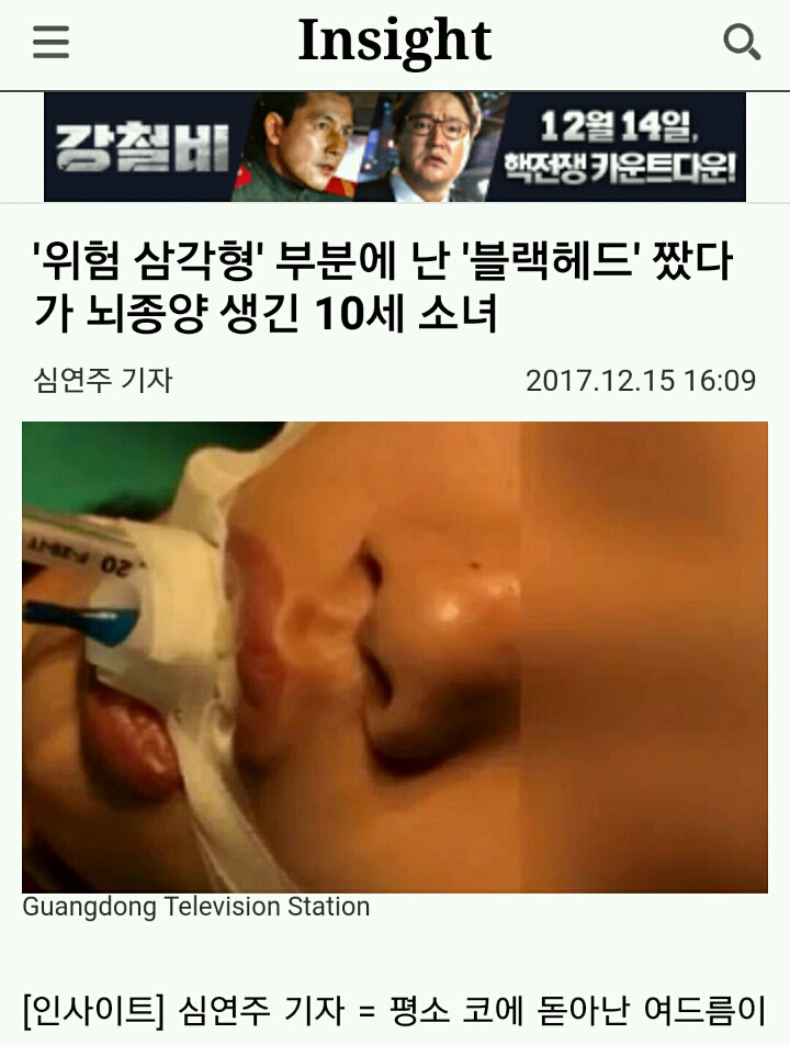 '위험 삼각형' 부분에 난 '블랙헤드' 짰다가 뇌종양 생긴 10세 소녀 | 인스티즈